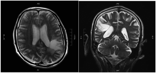 Figure 2. CS’s CT scan