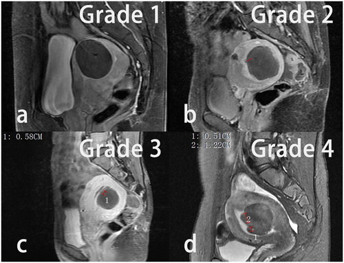 Figure 3. The schematic diagram of endometrial impairment grades indicated by red marks on postoperative magnetic resonance imaging. (a) Grade 0 (normal endometrium). (b) Grade 1 (pin-point, full-thickness discontinuity of involved endometrium). (c) Grade 2 (between grade 1 and 3). (d) Grade 3 (full-thickness discontinuity of involved endometrium over 1 cm in size).