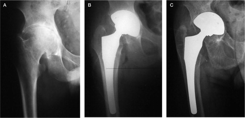 Figure 3.  The right hip of a 78-year-old man who had undergone hemodialysis for 13 years. A. Preoperatively, osteoarthritic changes with a Dorr type B femoral canal. B. Immediately after surgery (Porous-coated anatomic; PCA; Howmedica). C. 8 years after THA, showing loosening with migration of the components.