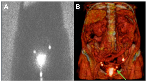 Figure 3 Endometrial cancer.