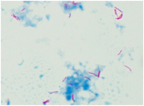 Figure 2. Microscopic examination of the Ziel-Neelsen stained sputum revealed acid-fast bacilli, suspicions for Mycobacterium.