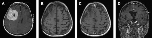 Figure 2 Preoperative contrast-enhanced T1-weighted MR image in the axial plane (A) of an 82-year-old woman operated on for a convexity meningioma. Last follow-up MRI examination obtained after Simpson grade I resection of an atypical meningioma (WHO grade II) with no postoperative radiotherapy showed no recurrence in the native T1-weighted image in the axial plane (B) and in contrast-enhanced T1-weighted images in the axial (C) and coronal (D) planes.