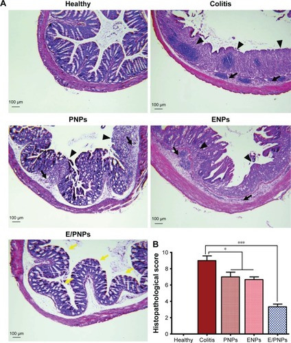 Figure 6 Histological evaluation of colon tissue. (A) H&E staining for microscopic evaluation of the colon sections isolated from healthy control, colitis control, and CSA-loaded nanoparticle-treated groups. Images of tissues are shown at 100× magnification. Arrowheads indicate disrupted epithelium, black arrows indicate inflammatory cell infiltration, and yellow arrows indicate re-epithelialization. (B) Histological score. Data are presented as mean±SD (n=3 animals/group). *p<0.05, ***p<0.001 compared with colitis control.Abbreviations: CSA, cyclosporine A; PNPs, poly(lactic-co-glycolic acid) (PLGA) nanoparticles; ENPs, Eudragit FS30D nanoparticles; E/PNPs, Eudragit FS30D/PLGA nanoparticles.