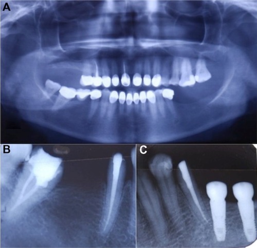 Figure 3 (A) Preoperative panoramic radiography. (B) Root canal treated teeth #45 and #47. (C) Root canal treatment of tooth #35 and two implants placed to replace missing teeth #36 and #37.
