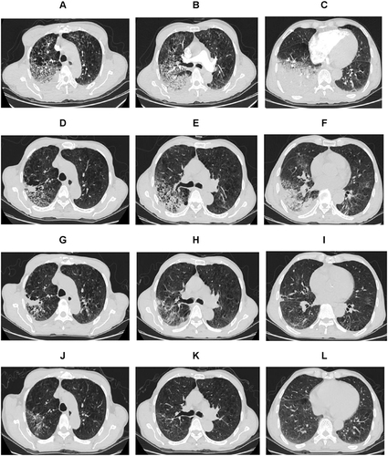 Figure 1 Chest CT findings of Severe Chlamydia psittaci pneumonia. (A–C) March 2, 2022: The day of admission. Large exudative foci in the right lung and a large consolidation shadow in the right lower lung. (D–F) Thirteen day after admission on March 15, 2022. Exudative foci and consolidation shadow in the right lung were less pronounced than those before. (G–I) Twenty-two day after admission on March 24, 2022. Further resorption of the right lung lesion than before. (J–L) April 24, 2022: 1 month after discharge. The lung lesions were largely resorbed, leaving only a small number of fibrous linear opacities.