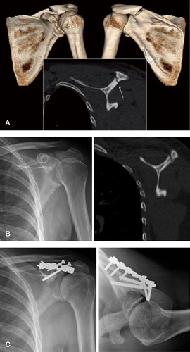 Figure 3 A. 2D- and 3D-CT scan of the scapula (patient 9) showing a minimally displaced fracture of the acromial base at the time of injury. B. AP radiography (left) and 2D-CT (right) of the scapula in the same patient 4 months after the injury, showing a nonunion of the acromial base. The patient complained of tenderness over the acromion and significant pain on movement of the shoulder. C. AP (left) and axillary (right) radiographs postoperatively, illustrating fixation using a 6-hole reconstruction plate, contoured to the acromial base, supplemented with two 3.5-mm cortical lag screws.