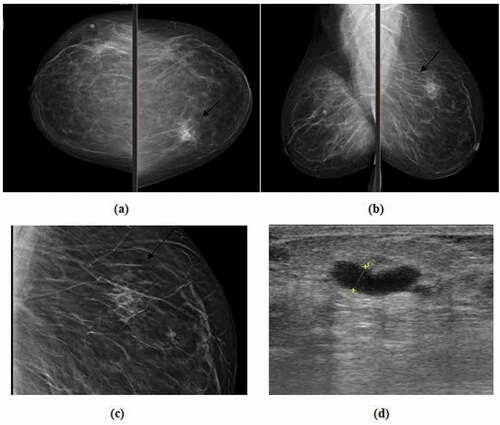 Figure 3. 54 years old patient complaining of left breast lump. (a) Craniocaudal, (b) mediolateral oblique DM images of both breasts revealed an area of focal asymmetry at the left upper inner quadrant, (c) Thin cuts tomosynthesis revealed internal fat density areas with central lucency. (d) Ultrasound showed a small hyper echoic area confined to the pre mammary region, with central cystic changes which was proved to be focal traumatic fat necrosis