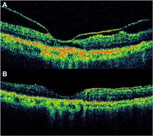 Figure 21 Vitreomacular traction syndrome and geographic atrophy.