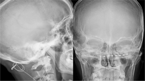 Figure 1 Lateral and anteroposterior X-ray images of the occipital electrode lead placement.