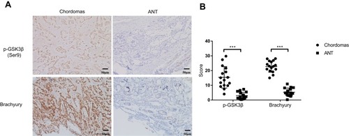 Figure 1 Protein level of p-GSK3β and brachyury were elevated in chordomas than adjacent normal tissues (ANT). (A) Representative photomicrographs in the left panel show positive immunoreactivity for p-GSK3β and brachyury in chordomas, while the right panel show adjacent normal tissues (ANT). (B) Histopathology scores processed with Image J. Magnification ×200. ***p< 0.001.