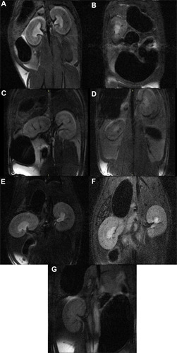 Figure 4 In vivo MR images of contrast evolution of Fe3O4@Au NPs in rats (A) saline control, at (B) 0 h, (C) 2 h, (D) 6 h, (E) 24 h, (F) 7 days, and (G) 14 days post-injection.