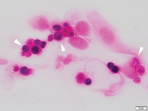 Figure 2 Photograph of a corneal smear with Gram staining. ×1000. Spherical Prototheca spp. organisms containing multiple endospores (morula-like form) can be seen in the corneal epithelial cells.