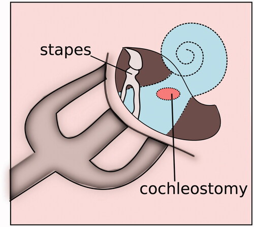 Figure 2. A topographical representation of intracochlear drug delivery through cochleostomy.