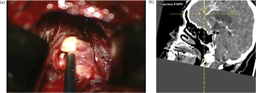 Figure 3. Intraoperative localization of the distal left ACA aneurysm. Left: The exposed aneurysm and the frameless stereotactic pointing device. Right: The trajectory view confirming the location of the aneurysm on the CT angiographic data set. [Color version available online.]