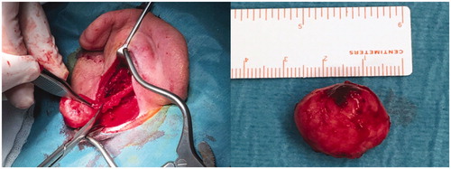 Figure 2. Surgical exploration showed a well circumscribed, not encapsulated soft tissue mass of 2 × 2 × 1 cms.