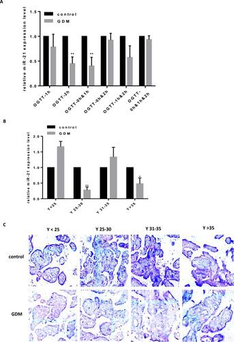 Figure 1 Reduced expression of miR-21 in the placenta of GDM patients and the expression of PPAR-α increases (A) Expression of miR-21 was detected in groups according to the OGTT time. n = 15 per group. (B) Expression of miR-21 in the placenta of GDM patients according to age. n = 15 per group. (C) Expression of miR-21 in the placental tissues of the GDM patients and normal pregnant women was detected by in situ hybridization using DIG-labeled LNA probes specific to miR-21. *P<0.05, **P<0.01.