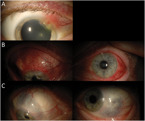 Figure 4. 45-year-old Caucasian male with bilateral idiopathic anterior diffuse scleritis and anterior uveitis in setting of orofacial herpes. A) Slit lamp photo of the right eye demonstrating nodular anterior scleritis with marginal keratitis at presentation. B) Slit lamp photos demonstrating development of anterior scleritis in the left eye and bilateral anterior uveitis despite treatment of local steroids and antivirals. C) Post-treatment with cyclophosphamide, repository corticotropin injection, cyclosporine and tocilizumab at 29 months; slit lamp photos show bilateral scleromalacia with no residual inflammation.