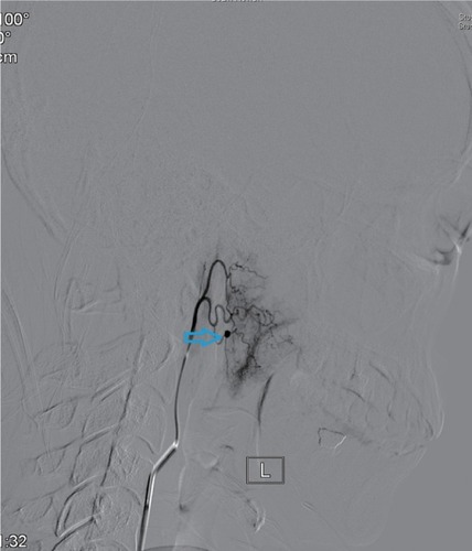 Figure 3 External carotid artery branch angiogram showing the bleeding sites on ascending pharyngeal artery (indicated by the arrow).Note: L= blood vessel on the left.
