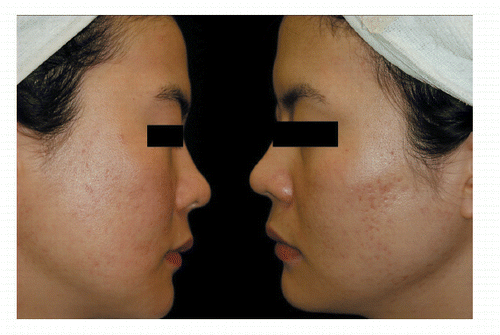 Figure 2. Two months after three treatments with the combination of the 595‐nm pulsed‐dye laser and fractional photothermolysis system.