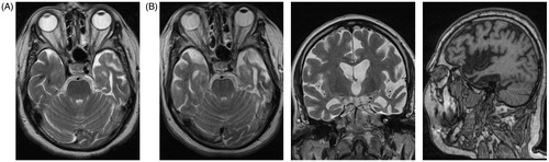 Figure 2. The initial axial T2 weighted MRI (A) showed left temporal lobe atrophy. The second scan made 2 years later (B) demonstrated bilateral temporal lobe and hippocampus atrophy (axial and coronal T2 weighted MRI), but more severe on the left side with a knife blade aspect of the temporal gyri while the general cerebral atrophy was limited (far right: sagittal T1 weighted MRI).