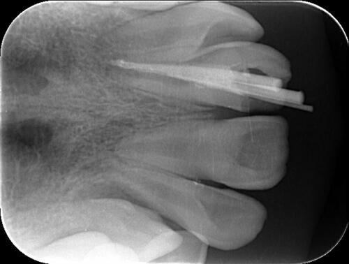 Figure 4 Filling with cold gutta-percha in tooth 21.