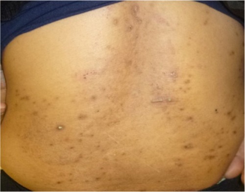 Figure 1 Clinical appearance of acquired perforating disease in a 58-year-old Japanese woman receiving hemodialysis.