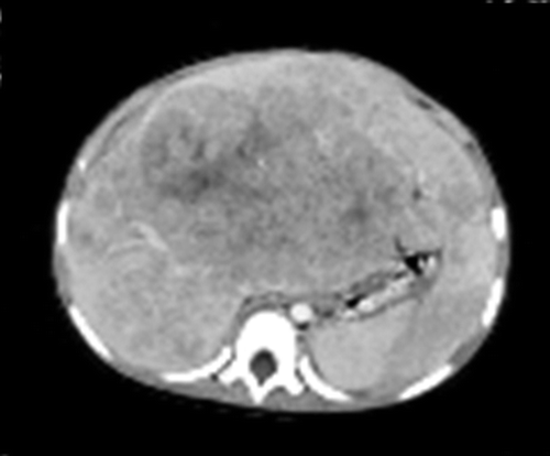 Figure 1. MRI at diagnosis.