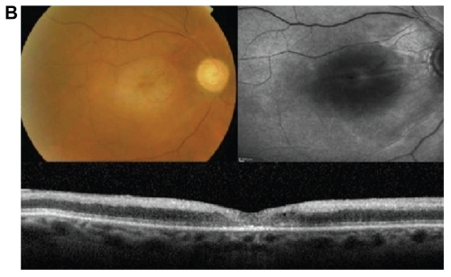 Figure 2b Fundus autofluorescence of the right eye (Case 2) at one month showing a recovery in the autofluorescence due to resolution of the cloudy swelling corresponding to the color photographs. The HD-OCT also show resolution of inner retinal thickening with preservation of outer retinal layers.