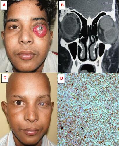 Figure 4 (A) Clinical photograph of a 15-year-old male patient with an orbital rhabdomyosarcoma in the left superior rectus muscle of the eye showing non-axial proptosis, marked chemosis and exposure keratopathy. (B) Computed tomography in the coronal view showing a large, round, well-defined, enhancing mass over the superior orbit, pushing the globe inferiorly. (C) Clinical photograph after five cycles of systemic neoadjuvant chemotherapy (vincristine, doxorubicin, and cyclophosphamide) showing complete regression of tumor and alopecia. (D) Immunohistochemical stains reveal positivity for vimentin within the cytoplasm of rhabdomyosarcoma cells.