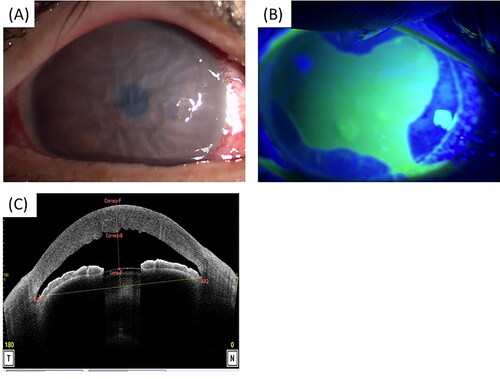 Figure 1. Ocular findings. Patient images of right eye. The left eye showed similar findings. (A) Anterior segment image upon hospital arrival. Severe epithelial defects observed in all corneas, including the limbs, bulbar conjunctiva, and corneal stromal edema. (B) Anterior segment image with fluorescein staining 13 days after chromium exposure. Extensive corneal epithelial defects persisted, suggesting the possibility of corneal limbal stem cell deficiency. (C) Anterior segment optical coherence tomography image 13 days after chromium exposure showing corneal stromal edema.