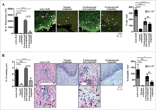 Figure 6. Increased IL-15 protein expression in esophageal biopsies from active EoE patients. (A) Immunofluorescence. Staining for IL-15 (green) and CD3 (red) was performed in 4 active EoE patients [4 x proximal and 4 x distal tissue samples], 2 normal control individuals [2 x proximal and 2 x distal tissue samples], 3 corticosteroid responders [3 x proximal and 3 x distal tissue samples] and 2 corticosteroid non-responders [2 x proximal and 2 x distal tissue samples]. Representative images are shown for each group. White arrows indicate examples of double stained cells, and filled white triangles indicate T cells without detectable IL-15 staining. Scale bars, 10 μm. Quantification of IL- 15 expression in epithelial cells is shown in the left panel. The right panel shows the quantitative analysis of infiltrating T cells that were either IL-15 negative (black bars) or positive (gray bars). (B) Immunohistochemistry. Staining for IL-15 (red) and ECP (brown) in active EoE, normal control individuals, corticosteroid responders, and corticosteroid non-responders (same esophageal tissues as described in panel A). Representative images are shown for each group. Insets demonstrate infiltrating eosinophils that are positive for IL-15 (black arrows) or IL-15 negative (filled black triangles). Scale bars, 10 μm. The right panel shows the quantitative analysis of infiltrating eosinophils that were either IL-15 negative (black bar) or positive (gray bar). Statistical analysis: one-way ANOVA followed by Tukey's multiple comparisons. ****p < 0.0001; ***p < 0.001; **p < 0.01; *p < 0.05.