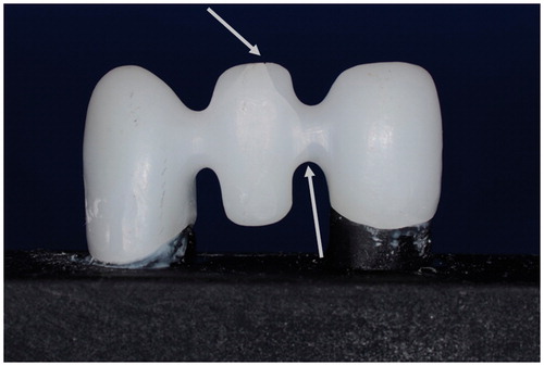 Figure 1. Fracture of a non-colored FDP framework propagating from the mesial side of the connector to the site of the indenter. Fracture marked by arrows.