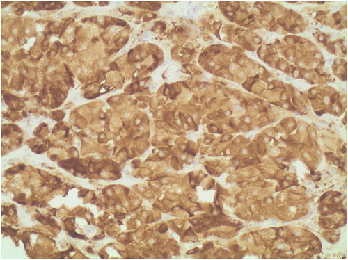 Figure 2: The immunohistochemical staining here demonstrates the universal positivity for inhibin, characteristic of steroid cell tumours.