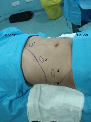 Figure 2 Suggested ultrasound probe positions for various approaches. (A) Initial scanning position for identification of linea alba and rectus abdominis, (B) probe position for subcostal approach, (C) probe position for lateral approach, (D) probe position for posterior approach.