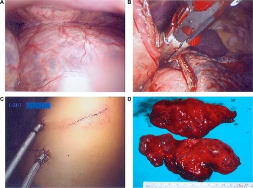 Figure 2 Video-assisted thoracoscopic surgery for patients with bullous emphysema. A) Giant bullae in the thoracic cavity; B) Endo-GIA stapling and resection; C) Operative wound and drainage; D) Resected bullae, gross picture.