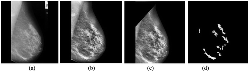 Figure 6. (a) Normal image mdb008 (b) Its preprocessed image (c) With pectoral muscles removed and (d) Segmented ROIs.