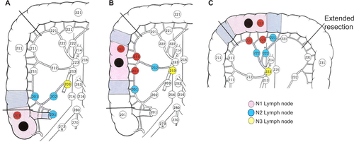 Figure S1 Lymph node mapping along the feeding artery and colonic wall for right-sided colon cancer.Notes: (A) Cecal cancer, (B) ascending colon cancer, and (C) transverse colon cancer. Copyright ©2012. Japanese Society of Clinical Oncology. Reproduced from Watanabe T, Itabashi M, Shimada Y, et al. Japanese Society for Cancer of the Colon and Rectum (JSCCR) guidelines 2010 for the treatment of colorectal cancer. Int J Clin Oncol. 2012;17(1):1–29.Citation1