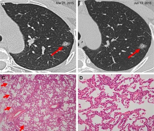 Figure 1 Adenocarcinoma in situ in a 44-year-old woman.