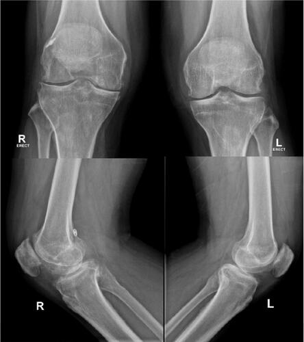 Figure 2 Plan X-ray of the knee shows early arthritic changes on the affected right knee compared to the left knee. On lateral view there is a button that remain on its position on the femoral side.