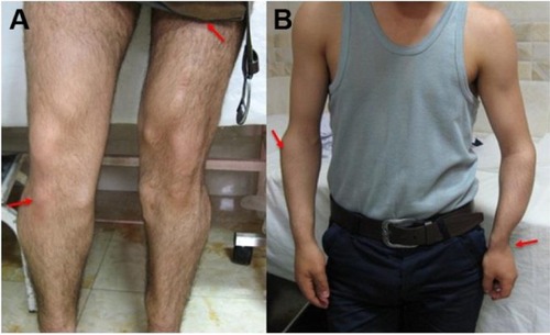 Figure 2 Hereditary multiple exostoses. (A) Multiple exostoses of the lower limbs (arrows). (B) Osteochondromas of the upper limbs (arrows).