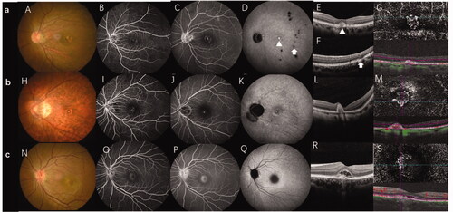 Figure 1. Multi-model imaging of MFC with CNV, mCNV, and ICNV. Line a: MFC with CNV. (A) The colour fundus photograph shows multiple small yellowish lesions and a few scattered atrophic spots. (B, C) FFA showing early hyperfluorescence and late leakage is the typical characteristic of type 2 CNV. (D) The late phases of ICGA show macular lesion with hyperfluorescence and there are multiple hypofluorescence spots which are greater in number and larger than those observed using fundus photography and FFA. (E) OCT scans corresponding to red arrowheads in image D demonstrate subretinal hyperreflective material overlying the RPE. (F) OCT scans corresponding to the green arrowhead in image D demonstrate that the photoreceptor layer around the lesion is lost; choroidal hyperreflectivity is well demonstrated here. (G) OCTA revealed detectable flow above the RPE. Line b: mCNV. (H) Colour fundus photograph of the left eye shows a tilted optic disc, posterior staphyloma, peripapillary atrophy, leopard fundus, and a greyish lesion surrounded with a hyperpigmented border at macular. (I, J) Early phase of the fluorescein angiogram showing very small, well-defined hyperfluorescence with minimal leakage in the late phases. (K) The late phases of ICGA show hyperfluorescence and a lacquer crack around the CNV. (L) OCT showing a hyper-reflective lesion corresponding to myopic CNV and a thinning choroidal layer. (M) OCTA shows detectable flow above the RPE. Line c: Typical ICNV. (N–R) The colour fundus photograph, FFA, and ICGA OCT of the ICNV showed there were only the typical characteristics of type 2 CNV. (S) The OCTA of the ICNV revealed detectable flow above the RPE. CNV: choroidal neovascularization; MFC: multifocal choroiditis; ICGA: indocyanine angiography; OCT: optical coherence tomography; FFA: fundus fluorescein angiography; mCNV: myopic choroidal neovascularization; ICNV: idiopathic choroidal neovascularization; RPE: retinal pigment epithelium; OCTA: optical coherence tomography angiography.