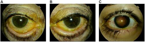 Figure 7 (A–C) Eyes with eyelash and eyelid complications.