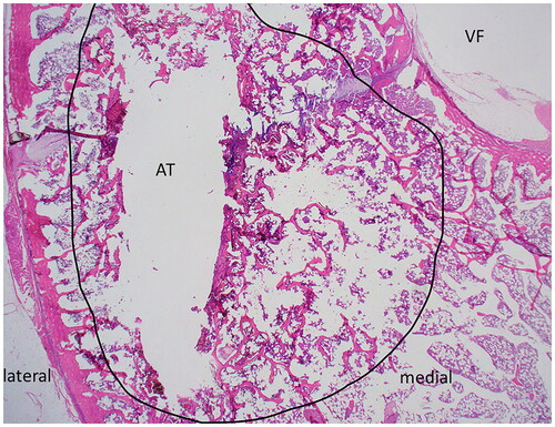 Figure 9. H&E stained slide of transverse section of ablated vertebrae L5. Medial and lateral margins are shown for orientation; the vertebral foramen (VF) and ablated tract (AT) are indicated. The region of thermal damage is circled in black.
