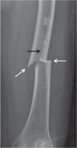 Figure 2. Bisphosphonate-associated shaft fractures show radiographic signs of stress fractures. Note the fracture line running perpendicular to the long axis of the femur and its origin at the tensional side of the bone. Black arrow: endosteal callus reaction. Horizontal white arrow: periosteal callus reaction. Oblique white arrow: medial spike.