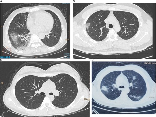 Figure 2. Lung computed tomography (CT) images of case 7 and case 8’s families. (A) The CT of their grandpa, who was 72-year-old and admitted for symptoms of high fever for 3 days. (B) CT scan of case their father, a 38-year-old patient admitted for symptoms of high fever, shortness of breath and fatigue for 10 days on his admission day. (C) Lung CT image of their mother, a 32-year-old female patient admitted for positive result of PCR (C). (D) Chest CT of the twins’ grandma, 65 years old and had fever, dry cough and chest pain for 6 days before admission.