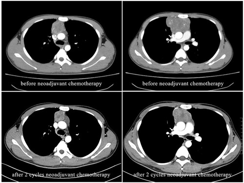 Figure 1 CT images showed partial tumor response to neoadjuvant chemotherapy.