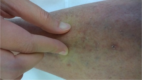 Figure 1 At presentation, there was linear thickening of skin of lower limbs with small discrete papules and areas of hyperpigmentation.