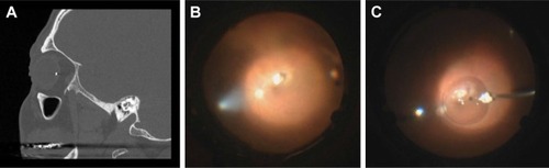 Figure 2 Case 2 with metallic IOFB. (A) Axial orbital CT with IOFB in the posterior segment of the left eye. (B) Intraoperative image of glass IOFB near the macula. (C) PFO moving metallic IOFB away from macula.