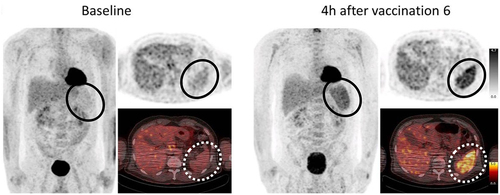 Figure 11. Targeting the human spleen using lipoplexes in systemic administration. 18F-2-deoxy-2-D-glucose positron emission tomography in a human after intravenous vaccination using anionic lipoplex. Spleens are encircled. Reproduced from [Citation190] under a creative commons attribution license (CC BY). Copyright © 2018 pektor et al.