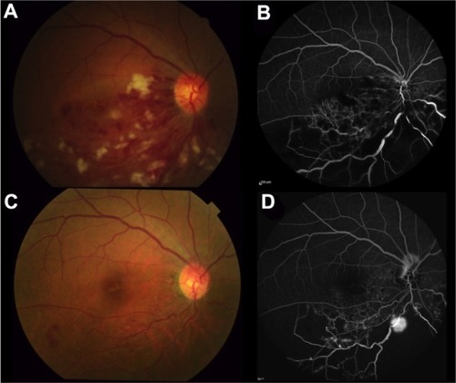 Figure 1 Color fundus photography and FA at the first visit (A and B) and at 6 months postpresentation (C and D).